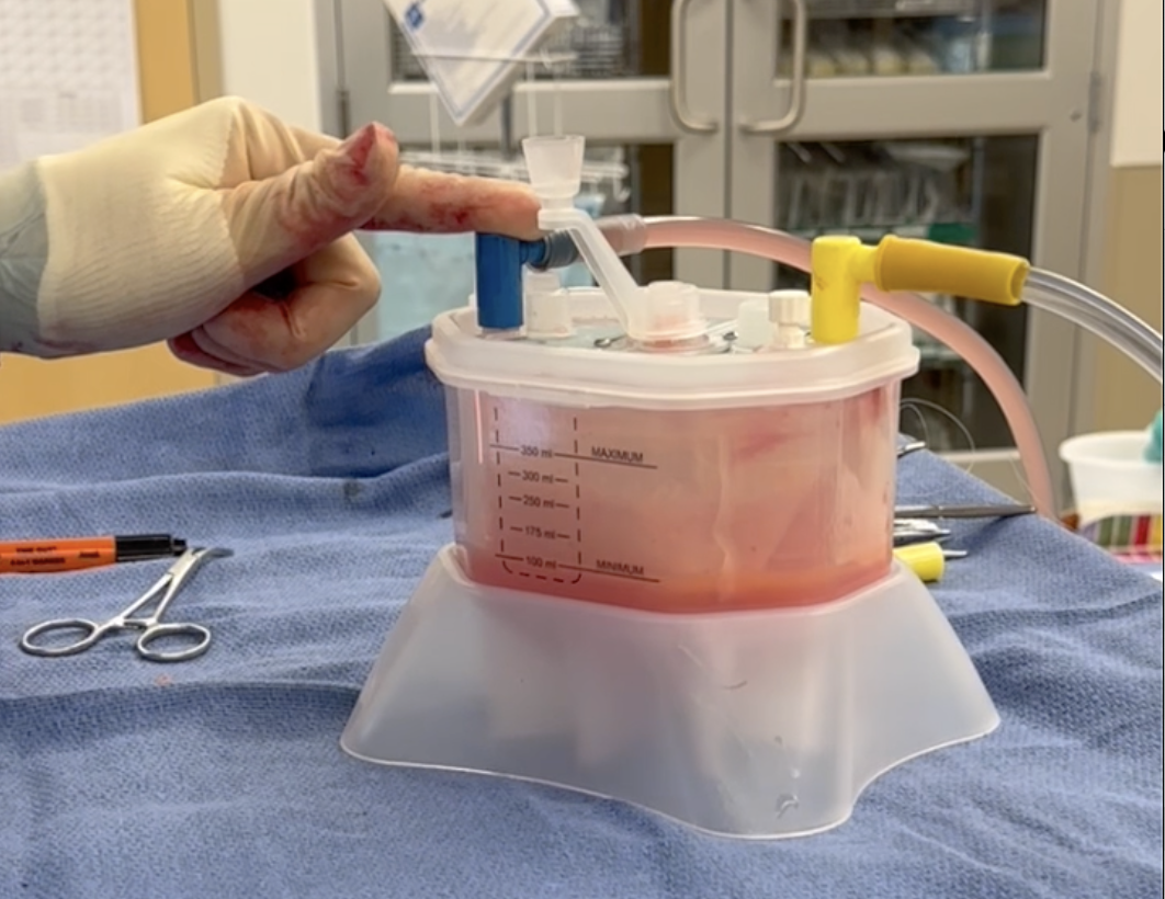 Featured image for “Fat grafting with the Revolve”